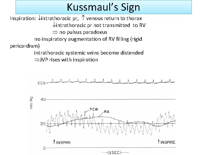 Kussmaul’s Sign Inspiration: intrathoracic pr, venous return to thorax intrathoracic pr not transmitted to