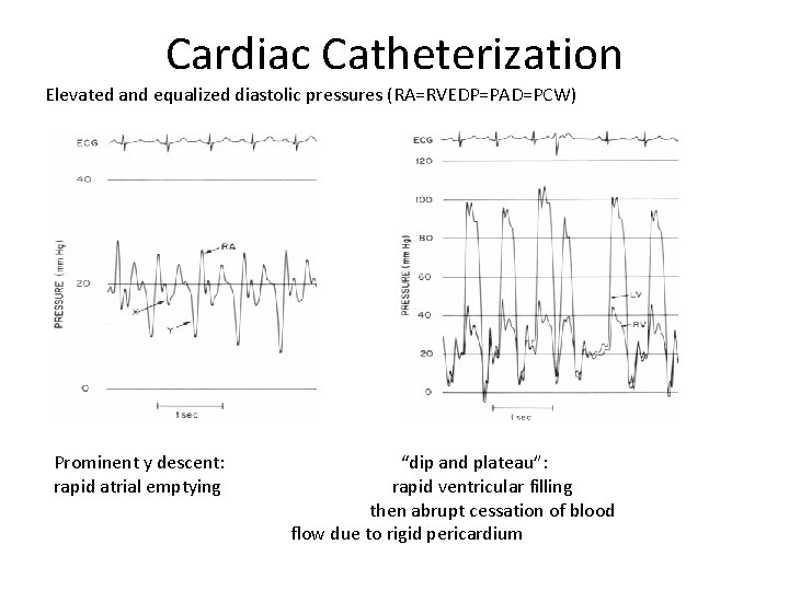 Cardiac Catheterization Elevated and equalized diastolic pressures (RA=RVEDP=PAD=PCW) Prominent y descent: rapid atrial emptying