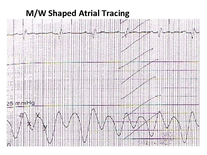 M/W Shaped Atrial Tracing 