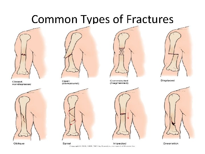 Common Types of Fractures 