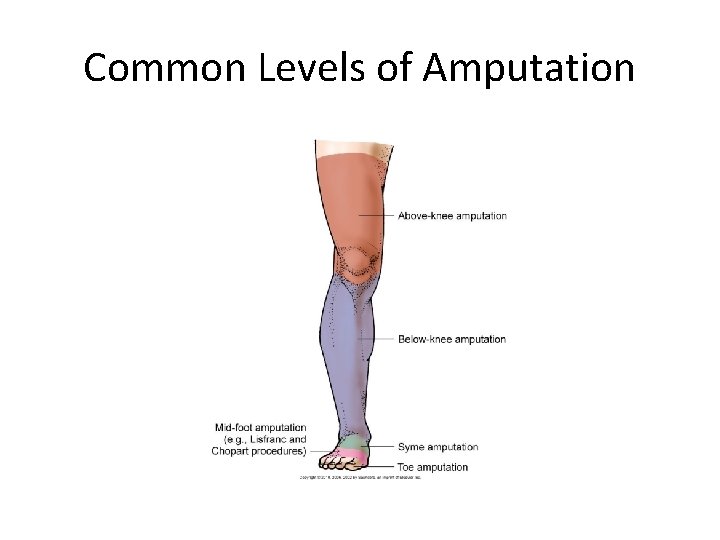 Common Levels of Amputation 