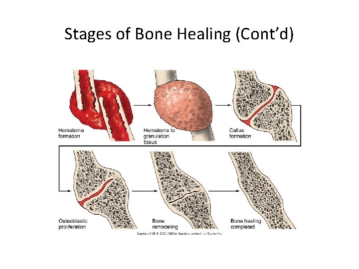 Stages of Bone Healing (Cont’d) 