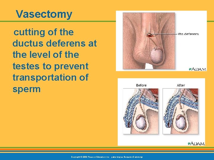 Vasectomy cutting of the ductus deferens at the level of the testes to prevent