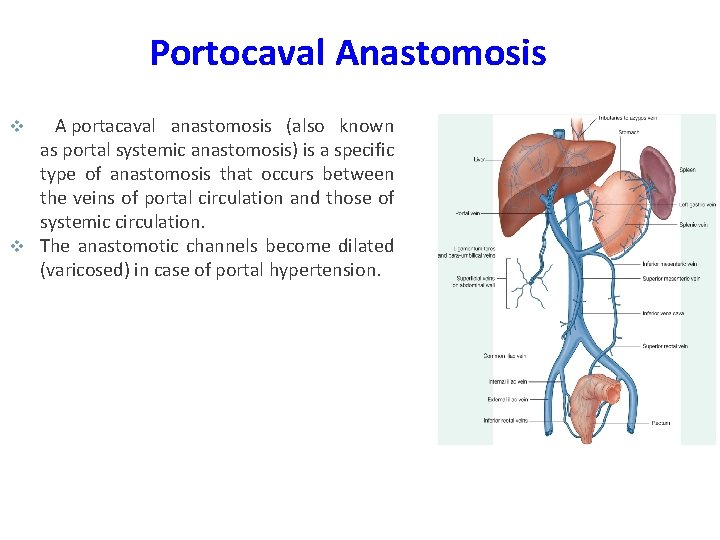 Portocaval Anastomosis A portacaval anastomosis (also known as portal systemic anastomosis) is a specific