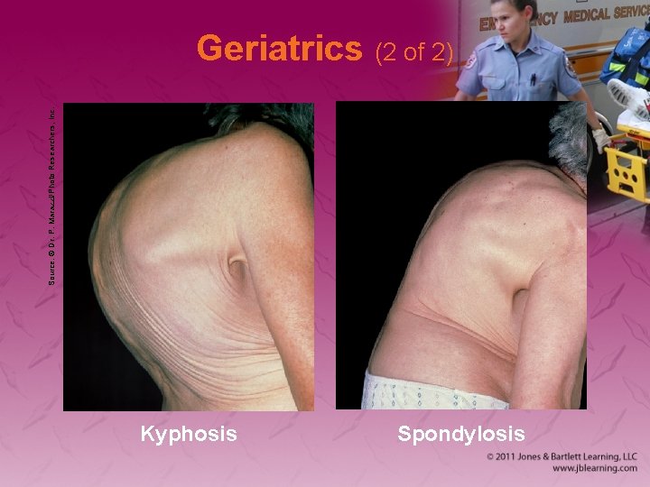 Source: © Dr. P. Marazzi/Photo Researchers, Inc. Geriatrics (2 of 2) Kyphosis Spondylosis 