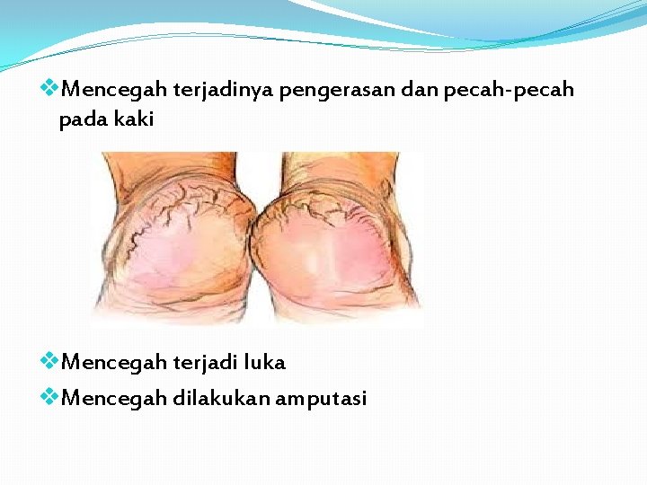 v. Mencegah terjadinya pengerasan dan pecah-pecah pada kaki v. Mencegah terjadi luka v. Mencegah