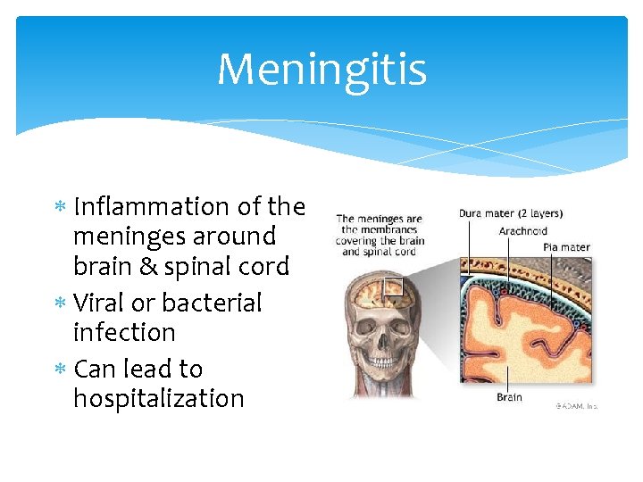 Meningitis Inflammation of the meninges around brain & spinal cord Viral or bacterial infection