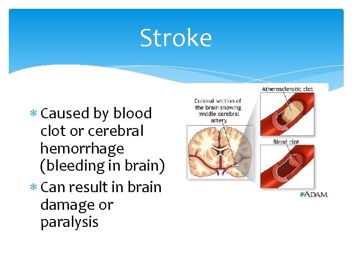 Stroke Caused by blood clot or cerebral hemorrhage (bleeding in brain) Can result in