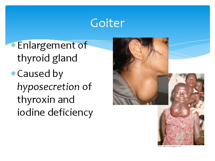Goiter Enlargement of thyroid gland Caused by hyposecretion of thyroxin and iodine deficiency 
