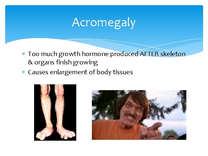 Acromegaly Too much growth hormone produced AFTER skeleton & organs finish growing Causes enlargement