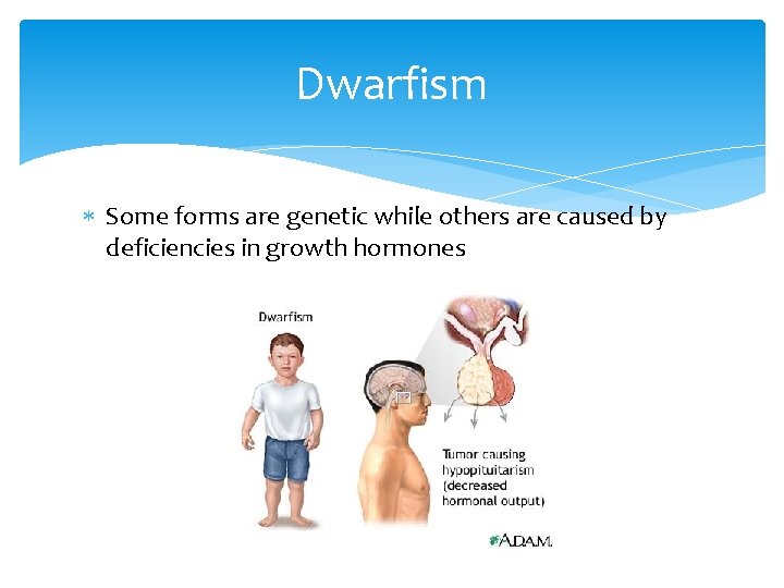 Dwarfism Some forms are genetic while others are caused by deficiencies in growth hormones