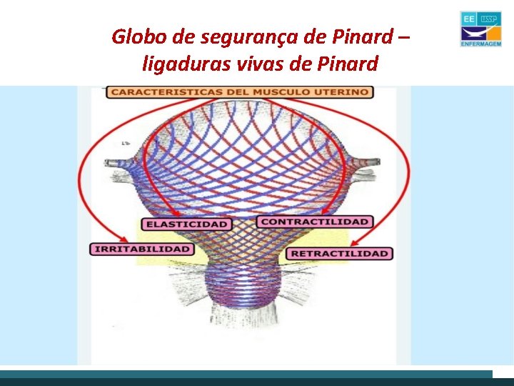 Globo de segurança de Pinard – ligaduras vivas de Pinard 