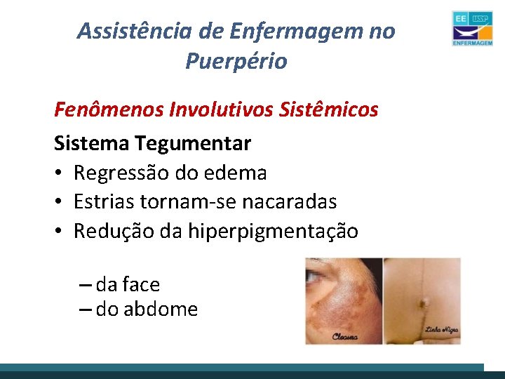 Assistência de Enfermagem no Puerpério Fenômenos Involutivos Sistêmicos Sistema Tegumentar • Regressão do edema