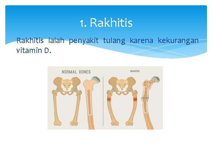 1. Rakhitis ialah penyakit tulang karena kekurangan vitamin D. 