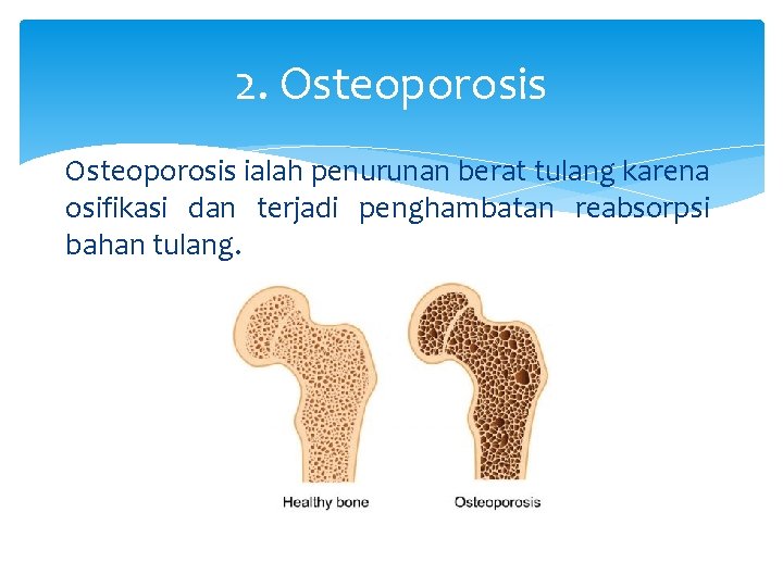 2. Osteoporosis ialah penurunan berat tulang karena osifikasi dan terjadi penghambatan reabsorpsi bahan tulang.