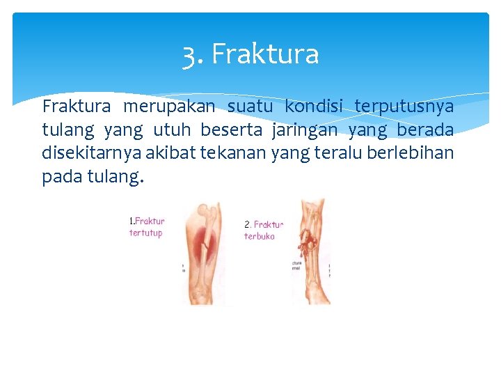 3. Fraktura merupakan suatu kondisi terputusnya tulang yang utuh beserta jaringan yang berada disekitarnya