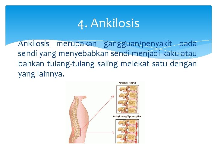 4. Ankilosis merupakan gangguan/penyakit pada sendi yang menyebabkan sendi menjadi kaku atau bahkan tulang-tulang