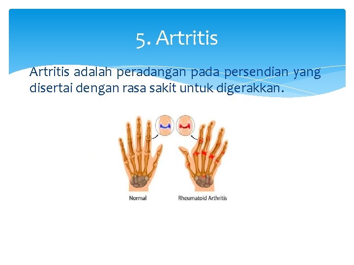 5. Artritis adalah peradangan pada persendian yang disertai dengan rasa sakit untuk digerakkan. 