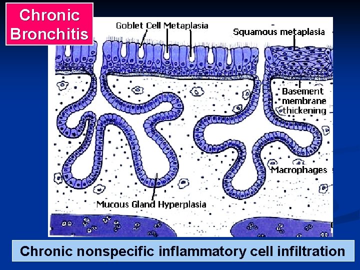 Chronic Bronchitis Chronic nonspecific inflammatory cell infiltration 