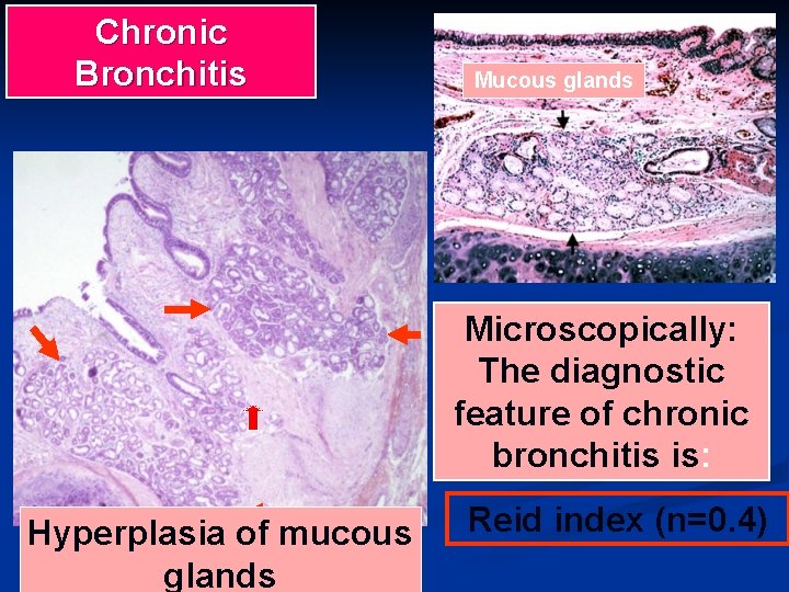 Chronic Bronchitis Mucous glands Microscopically: The diagnostic feature of chronic bronchitis is: Hyperplasia of