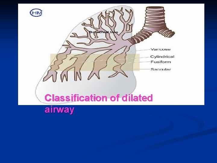 Classification of dilated airway 