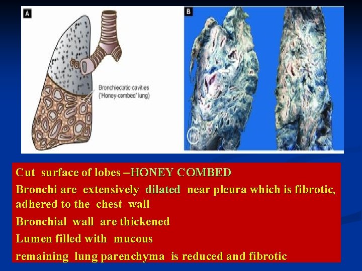 Cut surface of lobes –HONEY COMBED Bronchi are extensively dilated near pleura which is