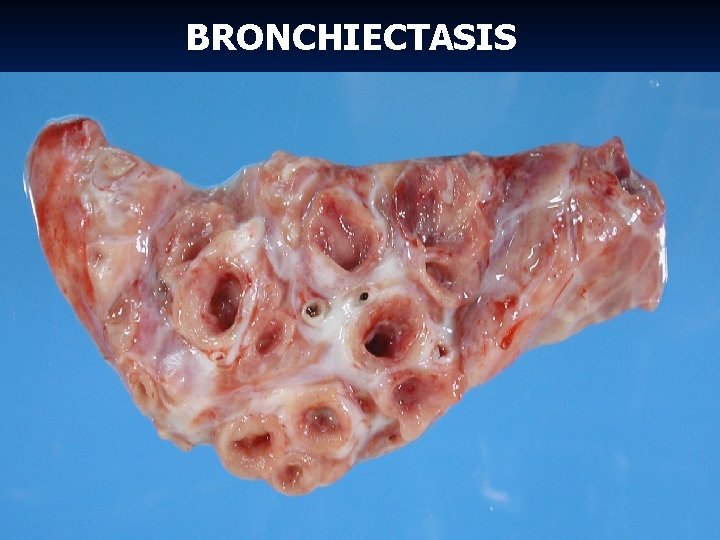 BRONCHIECTASIS 