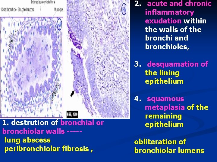 2. acute and chronic inflammatory exudation within the walls of the bronchi and bronchioles,