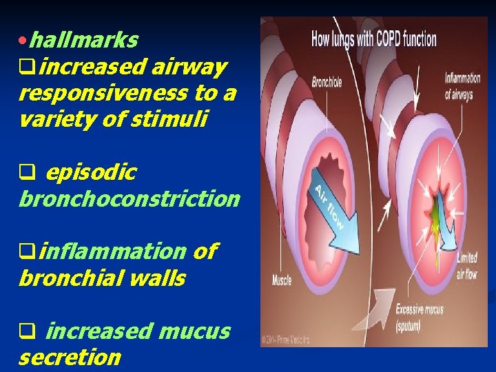 • hallmarks qincreased airway responsiveness to a variety of stimuli q episodic bronchoconstriction