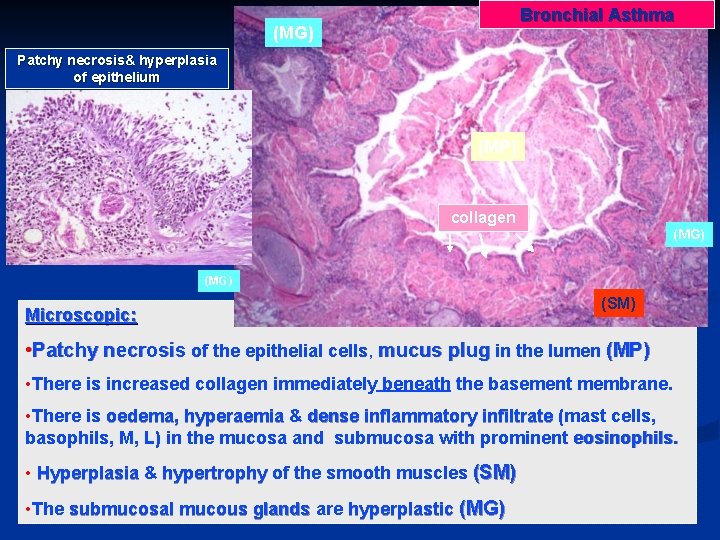 Bronchial Asthma (MG) Patchy necrosis& hyperplasia of epithelium (MP) collagen (MG) Microscopic: (SM) •