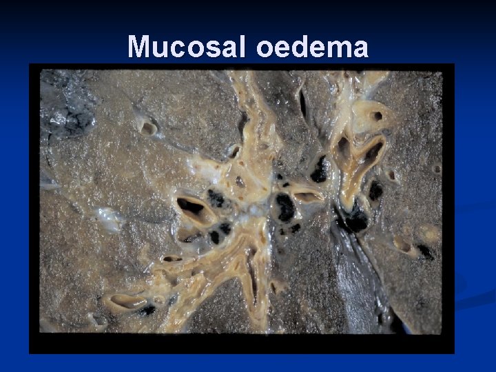 Mucosal oedema 