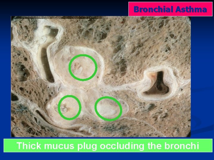 Bronchial Asthma Thick mucus plug occluding the bronchi 
