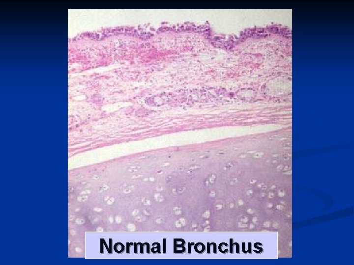 Normal Bronchus 