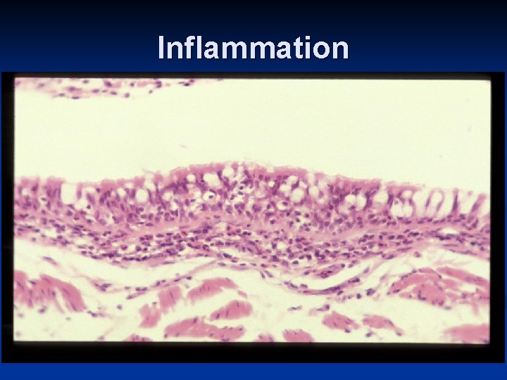 Inflammation 