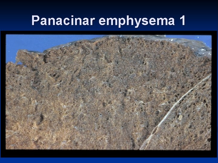 Panacinar emphysema 1 