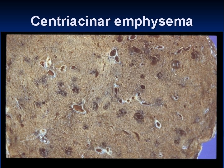 Centriacinar emphysema 