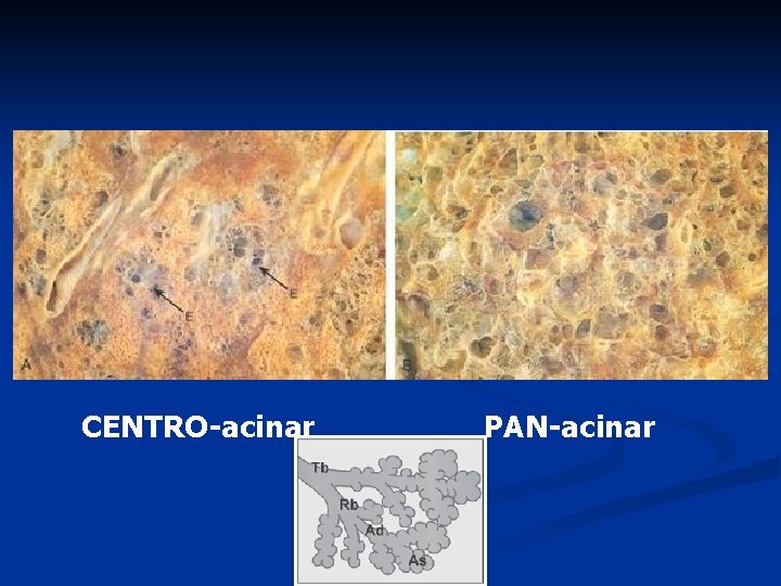 CENTRO-acinar PAN-acinar 