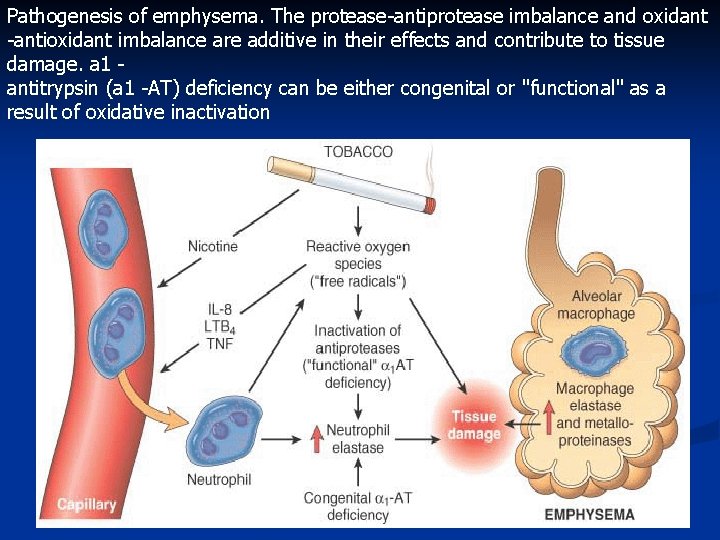 Pathogenesis of emphysema. The protease-antiprotease imbalance and oxidant -antioxidant imbalance are additive in their