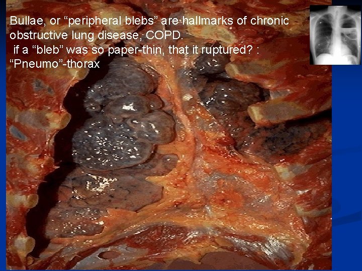 Bullae, or “peripheral blebs” are hallmarks of chronic obstructive lung disease, COPD. if a