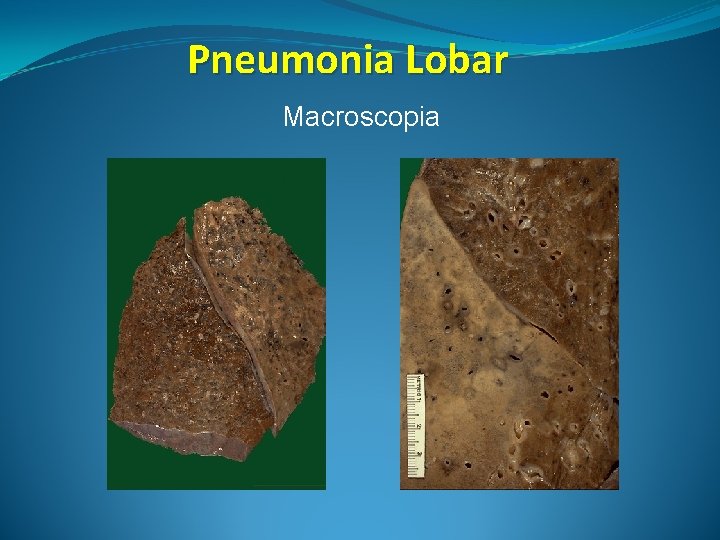 Pneumonia Lobar Macroscopia 