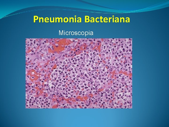 Pneumonia Bacteriana Microscopia 