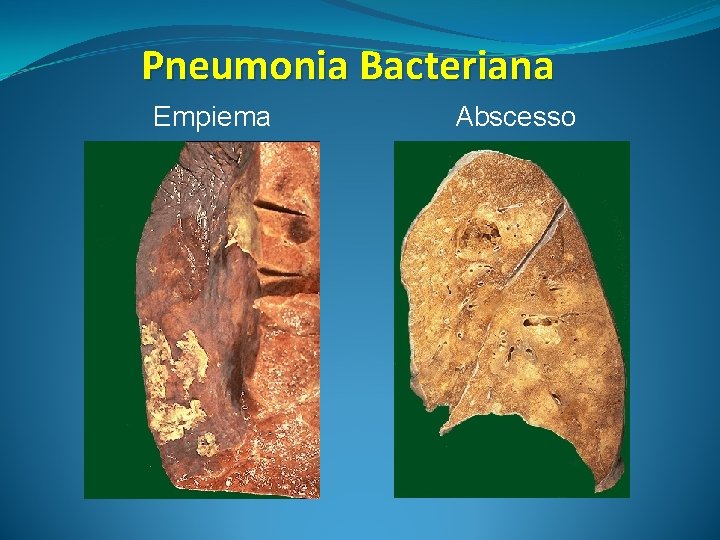 Pneumonia Bacteriana Empiema Abscesso 