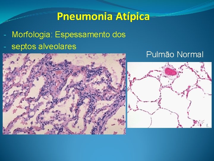 Pneumonia Atípica - Morfologia: Espessamento dos - septos alveolares Pulmão Normal 