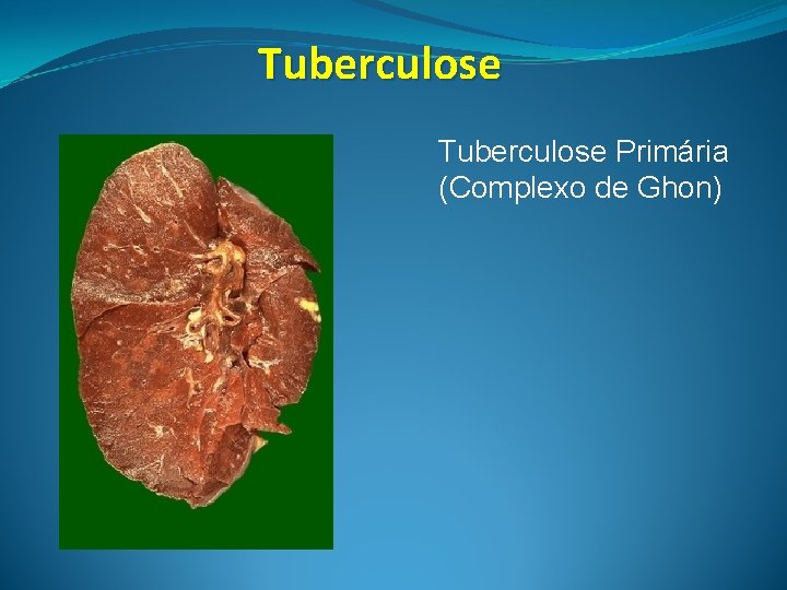 Tuberculose Primária (Complexo de Ghon) 