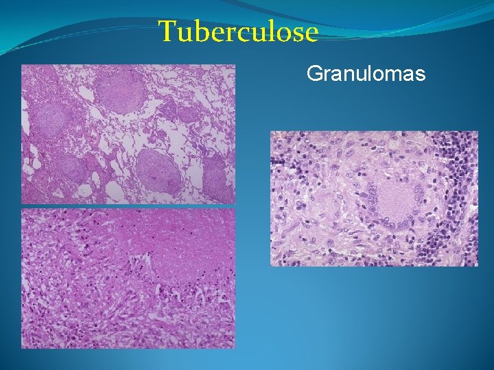 Tuberculose Granulomas 