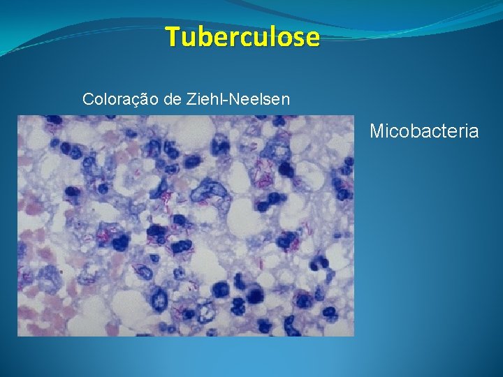 Tuberculose Coloração de Ziehl-Neelsen Micobacteria 