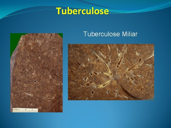 Tuberculose Miliar 