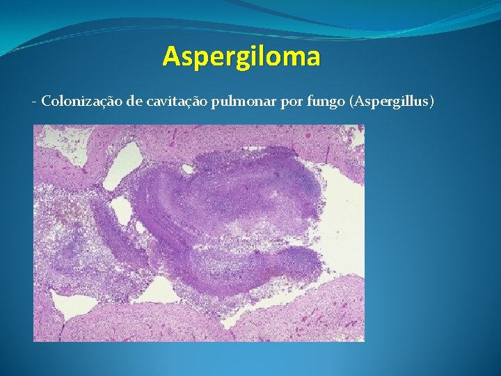 Aspergiloma - Colonização de cavitação pulmonar por fungo (Aspergillus) 