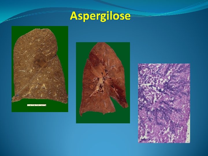 Aspergilose 