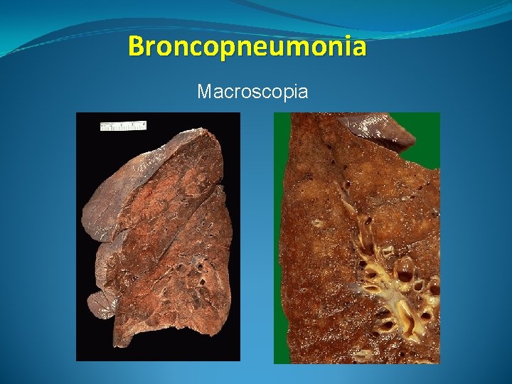 Broncopneumonia Macroscopia 